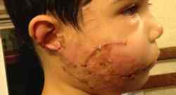 Some of the injuries that Las Vegas boy Carlos Blakely suffered in vicious dog attack can be seen in this photo.