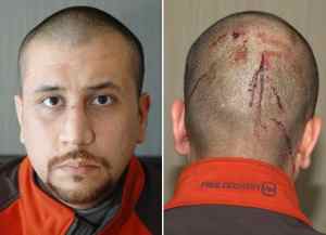 George Zimmerman not guilty cerdict.  Photos shows head gashes that Zimmerman received after he says he was attacked by Trayvon Martin.