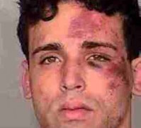 Joey Kadmiri police photo showing bruises sustained in fight at Excalibur Las Vegas.