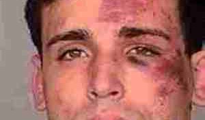 Joey Kadmiri police photo showing bruises sustained in fight at Excalibur Las Vegas.